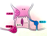 痔の種類