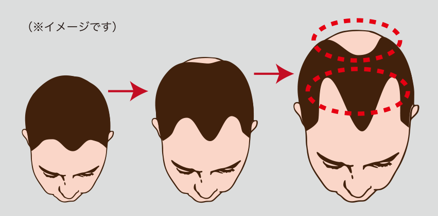 DHTが毛母細胞を攻撃し毛髪の成長を阻害！